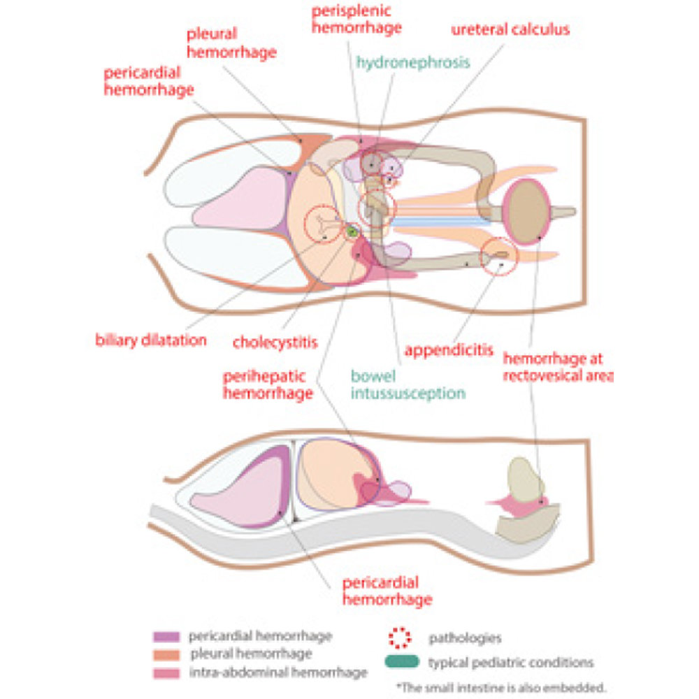 Paediatric FAST/Acute Abdomen Phantom