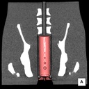 CT Colonography Phantom NCCS