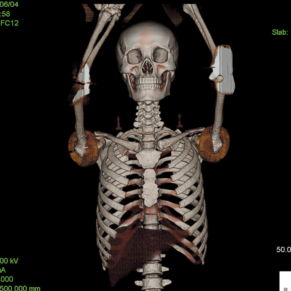 CT Whole Body Phantom "PBU-60"