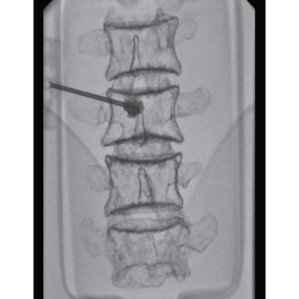 Lumbar Spine Fluoroscopy Training Phantom