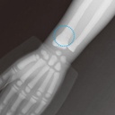 Paediatric Bone Fracture Phantom "PBU-70B"